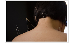 acupuncture picture